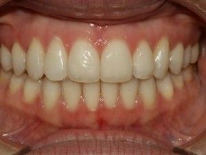 Zahnregulierung